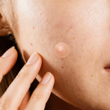 Acne Patches – Roll-Shaped Hydrocolloid, Lightweight, Breathable, Transparent & Invisible Skin Care Patches